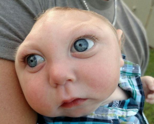 Bayi Tanpa Tengkorak Kepala Bertahan Hidup