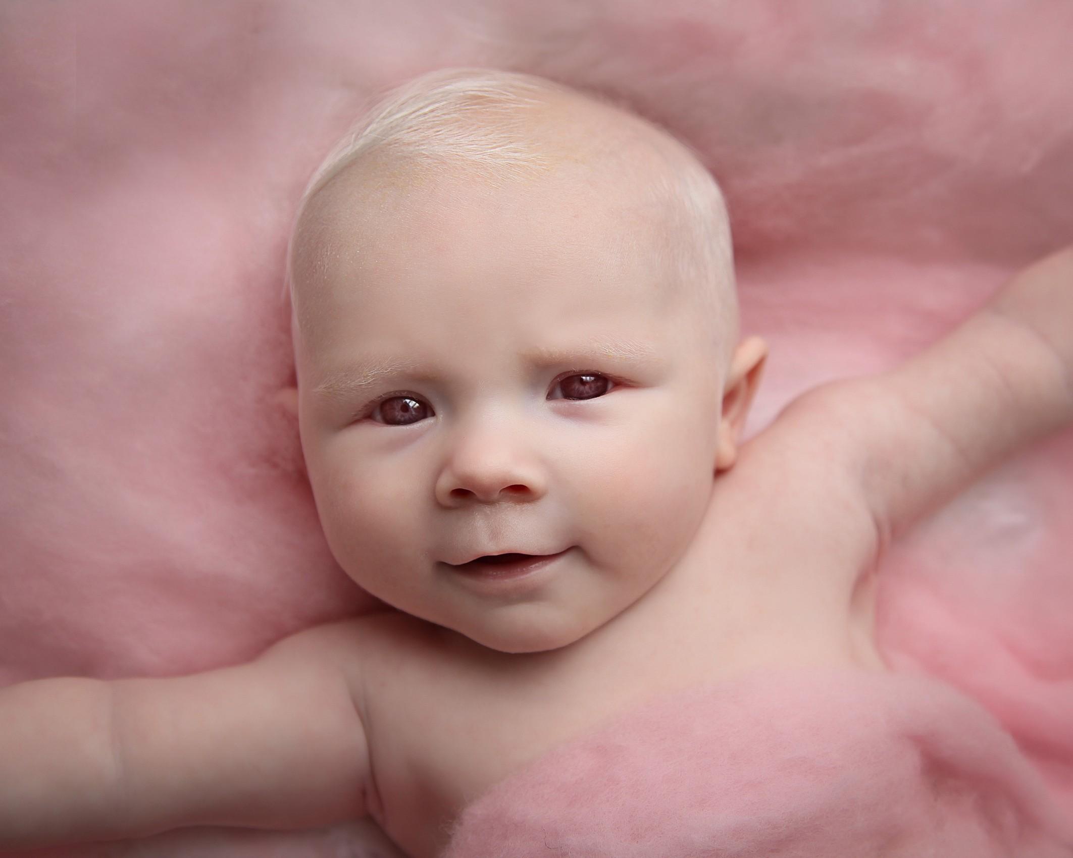 Apa itu albino pada bayi