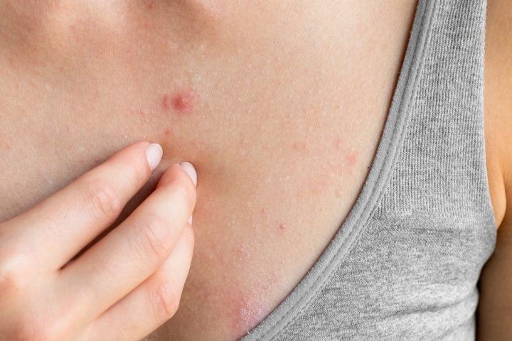 Cara Ampuh Mengobati Bintik Merah pada Kulit yang Disertai Gatal