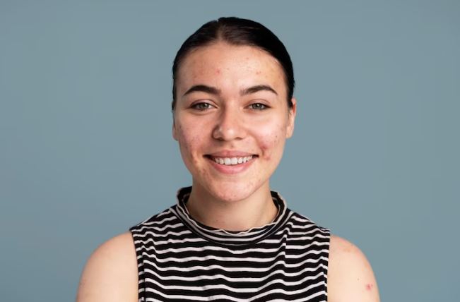 Punya Bekas Jerawat Kemerahan? Begini Cara Menghilangkannya