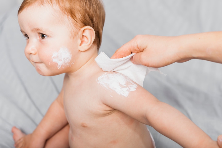 10 Obat Biang Keringat pada Bayi yang Aman dan Efektif