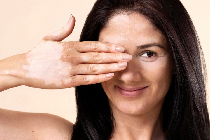 Warna Kulit Bisa Berubah, Waspada Faktor Penyebabnya