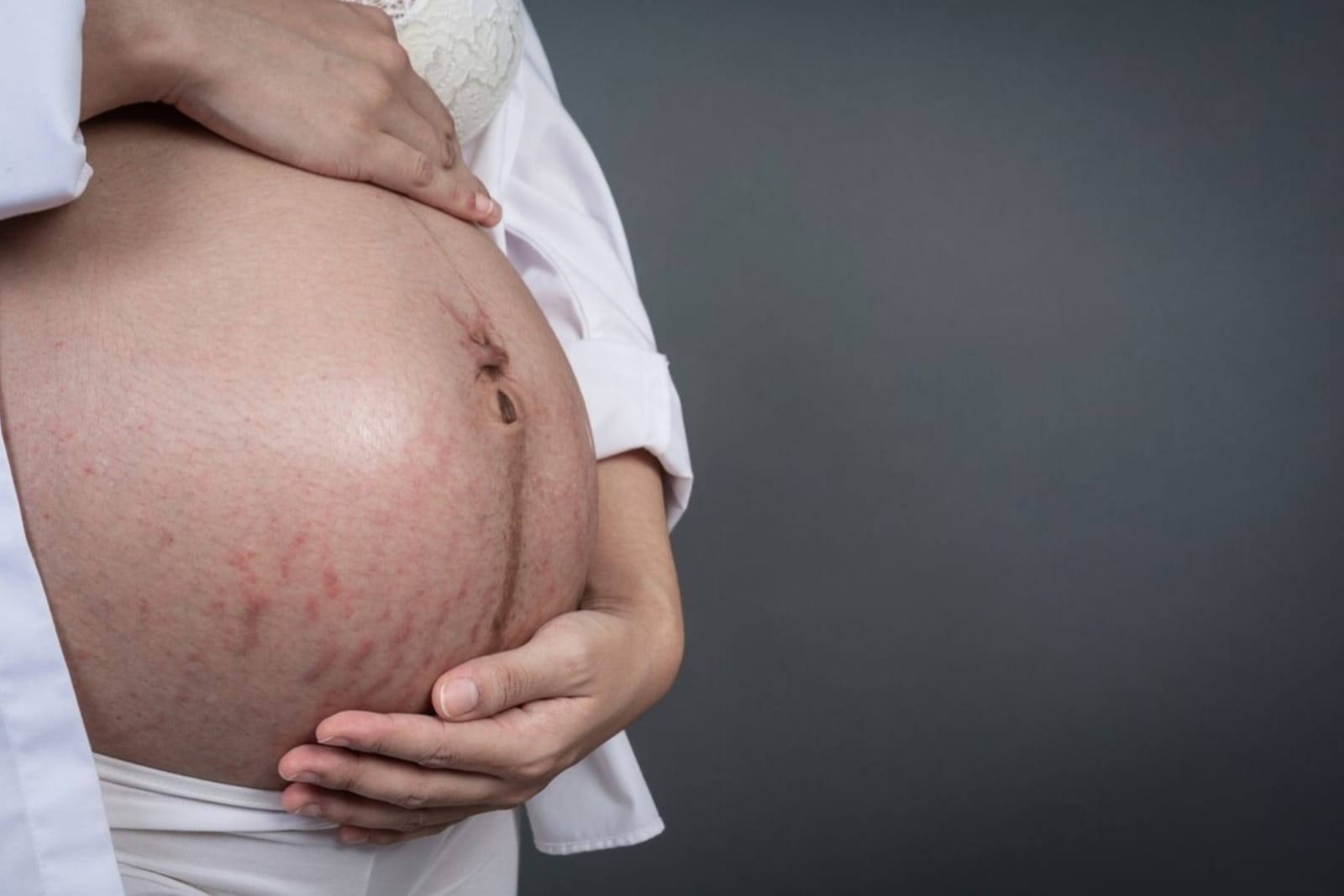 Rahasia Merawat Stretch Marks dengan Perawatan Kulit yang Tepat