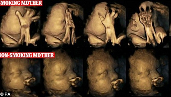 Hasil USG Bayi dengan Ibu Perokok