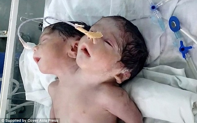 Bayi Berkepala 2 Ini Hanya Bertahan Hidup 32 Jam