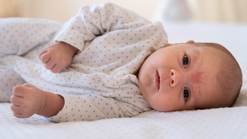 Hemangioma pada Bayi: Kenali Ciri, Penyebab, dan Penanganannya