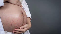 Rahasia Merawat Stretch Marks dengan Perawatan Kulit yang Tepat