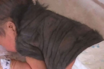 Astaga, Bayi 'Werewolf' Lahir di China!