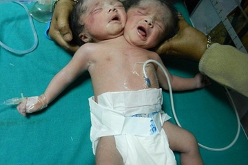 Bayi Berkepala 2 Lahir di Bangladesh