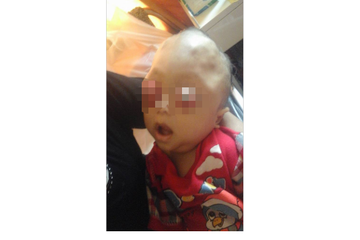 Bayi Asal Lampung Terserang Tumor Mata
