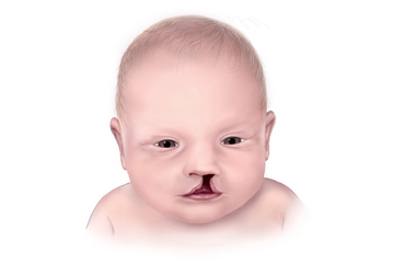 Penyebab Bibir Sumbing pada Anak, bisa Karena Makeup!