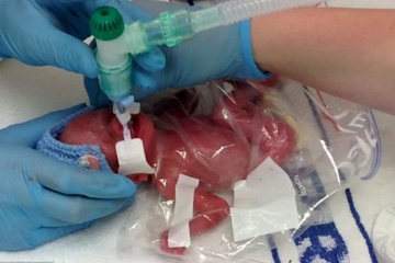 Lucia, Bayi Prematur yang Bertahan Hidup