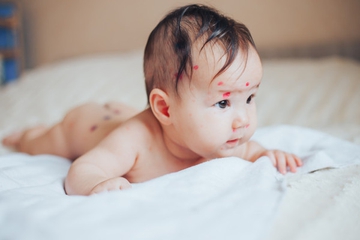Waspadai 7 Masalah Kulit pada Bayi Baru Lahir