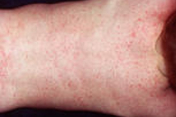 Waspadai Infeksi Virus Roseola 