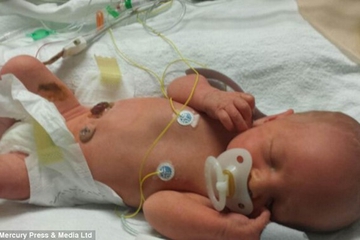 Bayi Lahir Dengan Gastroschisis