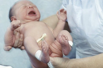 Waspada Hipotiroid pada Bayi