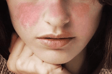 Wanita Lebih Rentan Penyakit Lupus Ketimbang Pria, Lho!