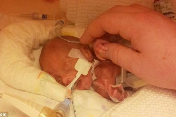 Kisah Kelahiran Bayi Prematur 1 Kilogram