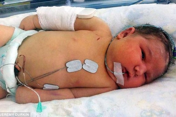 Bayi Dipatahkan Tangannya Agar Bisa Dilahirkan