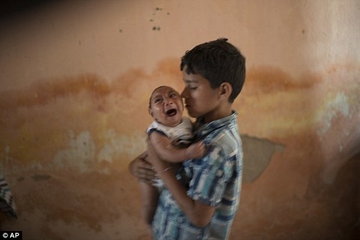 Virus Zika Sebabkan Bayi Lahir Berkepala Kecil