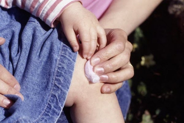 Penanganan Perdarahan Luar Pada Anak Hemofilia