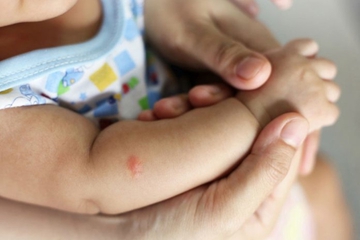 Bisul pada Bayi, Ini Penyebab dan Cara Mengatasinya