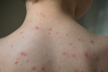 Dampak Herpes Zoster