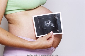 Diagnosa Placenta Accreta (2) 