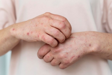 Kasus Meningkat, Waspadai Mpox atau Cacar Monyet, Ini Gejala dan Pencegahannya
