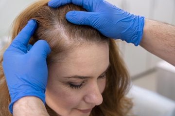 8 Penyebab Kebotakan Rambut yang Terjadi pada Pria dan Wanita