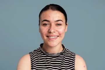 Punya Bekas Jerawat Kemerahan? Begini Cara Menghilangkannya