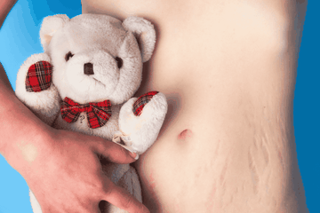 Cara Ampuh dan Aman untuk Menghilangkan Stretch Mark Setelah Melahirkan