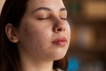 Bukan Cuma Salah Skincare, Ini Penyebab Bruntusan di Pipi