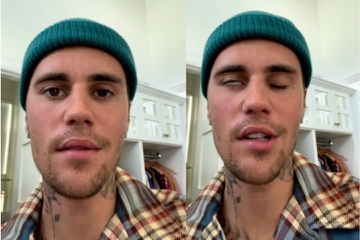 Kenali Ramsay Hunt Syndrome, Penyebab Wajah Justin Bieber Lumpuh