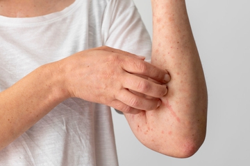 Mengenal Jenis-jenis Dermatitis dan Penyebabnya yang Perlu Anda Tahu
