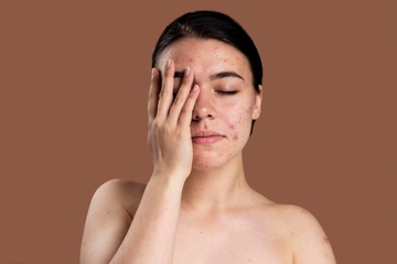 7 Tips Menghilangkan Bruntusan di Jidat dengan Cara Alami dan Efektif