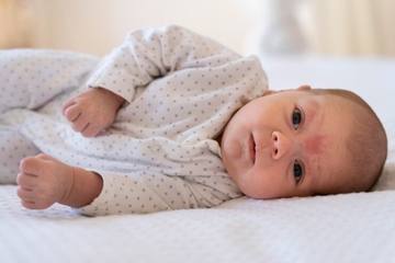 Infeksi Kulit pada Bayi, Ini Penyebab dan Cara Mencegahnya