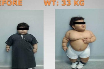 Balita Dioperasi karena Obesitas
