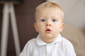 5 Penyakit Akibat Gigitan Kutu Binatang pada Anak