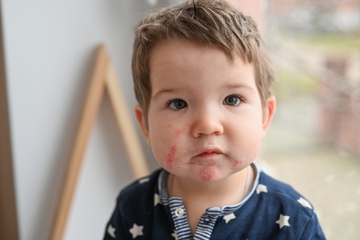 World Allergy Week 2020: Cara Cegah Alergi Anak dari Rumah