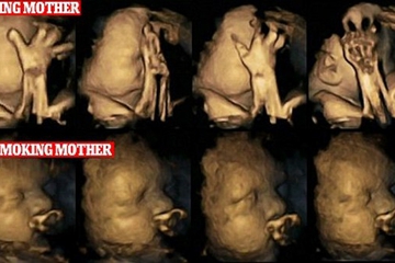 Hasil USG Bayi dengan Ibu Perokok