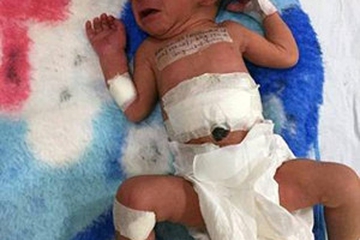 Bayi dengan Kembar Parasit Berhasil Dioperasi