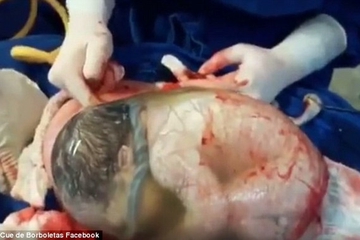 Bayi Ini Lahir Masih Terbungkus Kantung Ketuban!