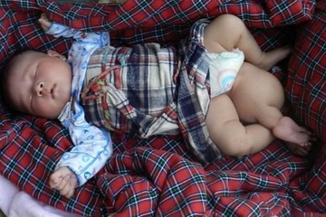 Bayi Lahir dengan Tiga Kaki