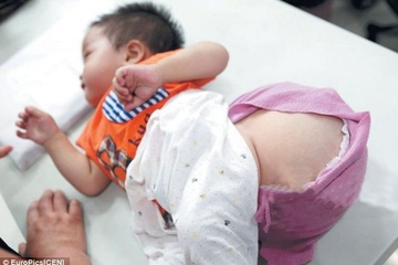 Anak Menderita Tumor Sebesar Melon 