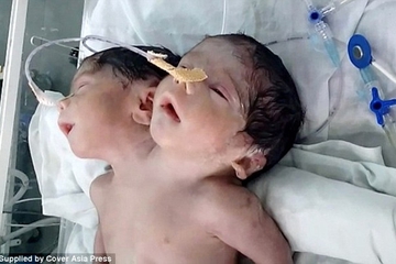 Bayi Berkepala 2 Ini Hanya Bertahan Hidup 32 Jam
