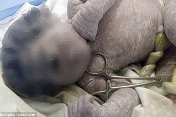 Bayi Bermata Satu Dilahirkan di Mesir