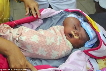 Bayi Lahir dengan Kepala Berbentuk Hati