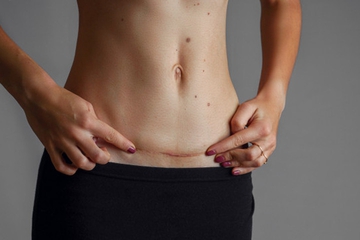 Moms, Hindari Melakukan Ini Usai Operasi Caesar!