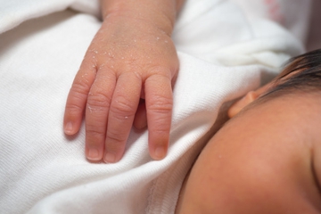 Kulit Bayi Baru Lahir Mengelupas, Ini Penyebab dan Cara Atasinya